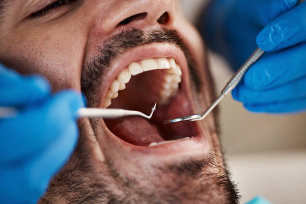 Best Emergency Dentist for Lost Fillings or Crowns in Haw River, NC